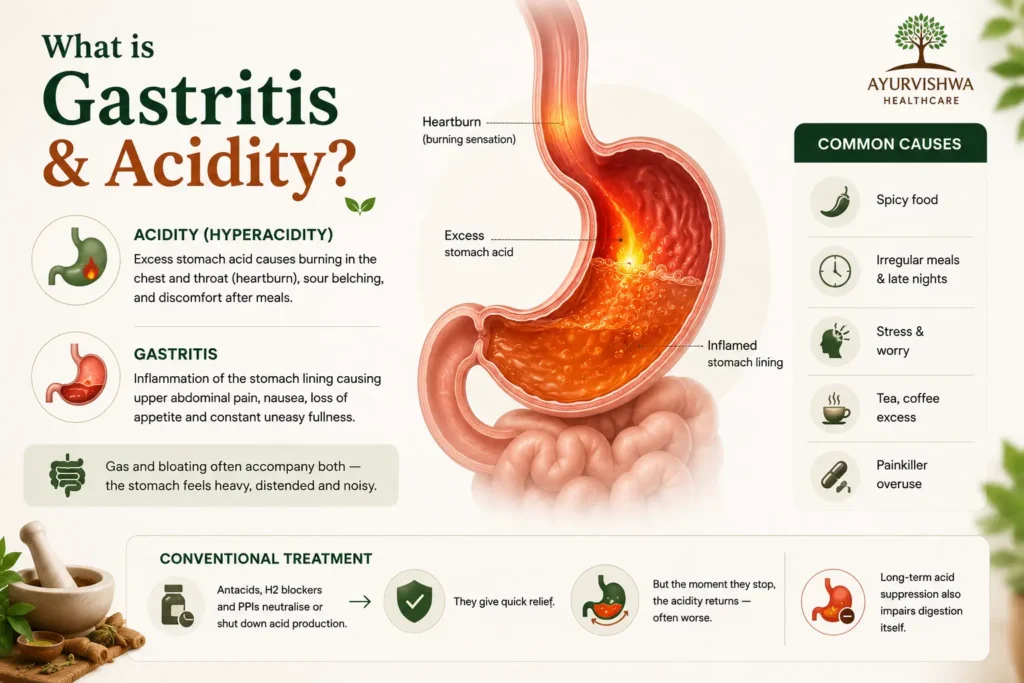 Medical infographic illustrating gastritis and acidity with a detailed stomach anatomy showing excess stomach acid, inflamed stomach lining, heartburn, and digestive discomfort, alongside common triggers such as spicy food, stress, irregular meals, tea and coffee, supporting awareness of ayurvedic treatment for acidity, ayurvedic medicine for acidity and gas, gastritis treatment in Ayurveda, ayurvedic treatment for acid reflux, and consultation with an ayurvedic doctor for acidity and gastritis.