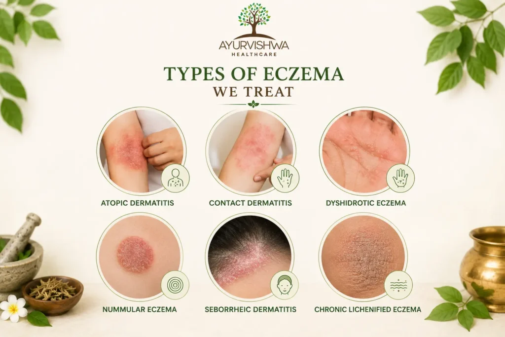 Ayurvishwa Healthcare Ayurvedic illustration showing six types of eczema: atopic dermatitis, contact dermatitis, dyshidrotic eczema, nummular eczema, seborrheic dermatitis, and chronic lichenified eczema.